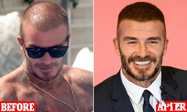 贝克汉姆什么原因脱发,贝克汉姆严重脱发