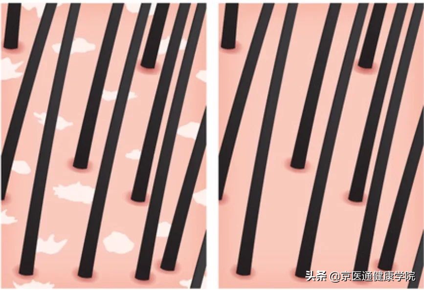 皮肤科去头屑,张文鹤医生碘伏去头屑