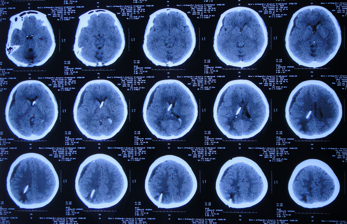 脑出血后脑积水会造成意识不清吗,脑出血后脑积水发高烧危险期多久