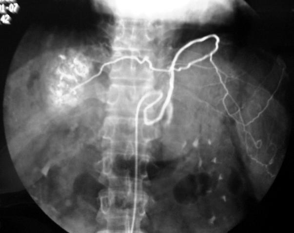 微创介入手术真实经历,介入手术是不是就是微创手术
