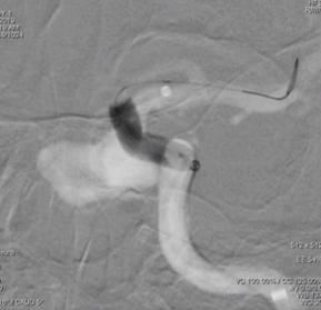 颈内动脉c3段动脉瘤是什么症状,右颈内动脉c3段动脉瘤是什么意思