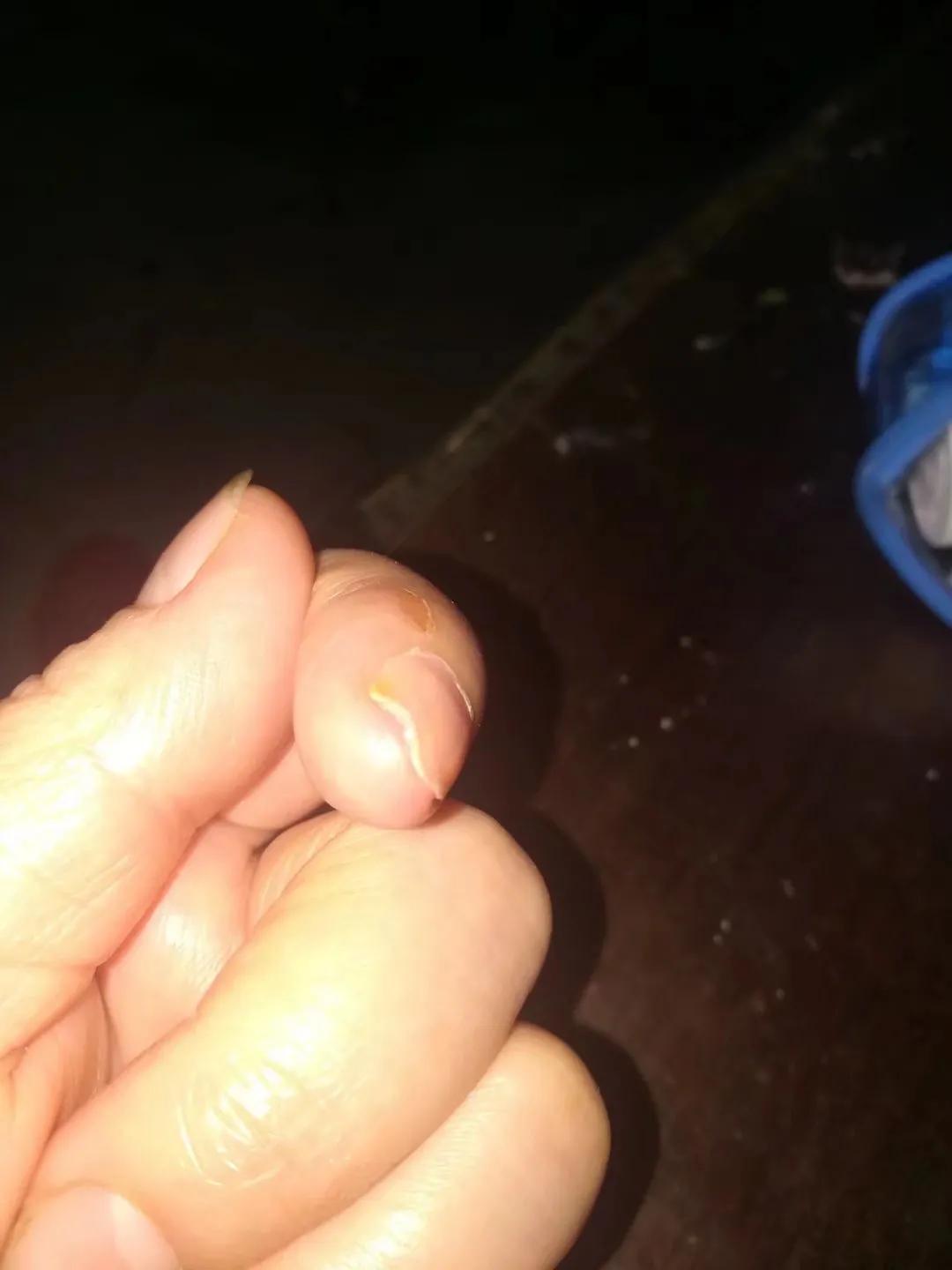 连续性肢端皮炎掉痂了是好转吗,连续性肢端皮炎需要拔指甲吗