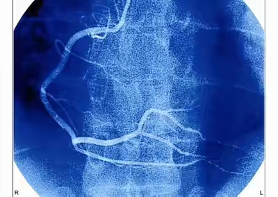 心肌缺血引起心绞痛怎么办,心肌缺血引起的心绞痛怎么治疗