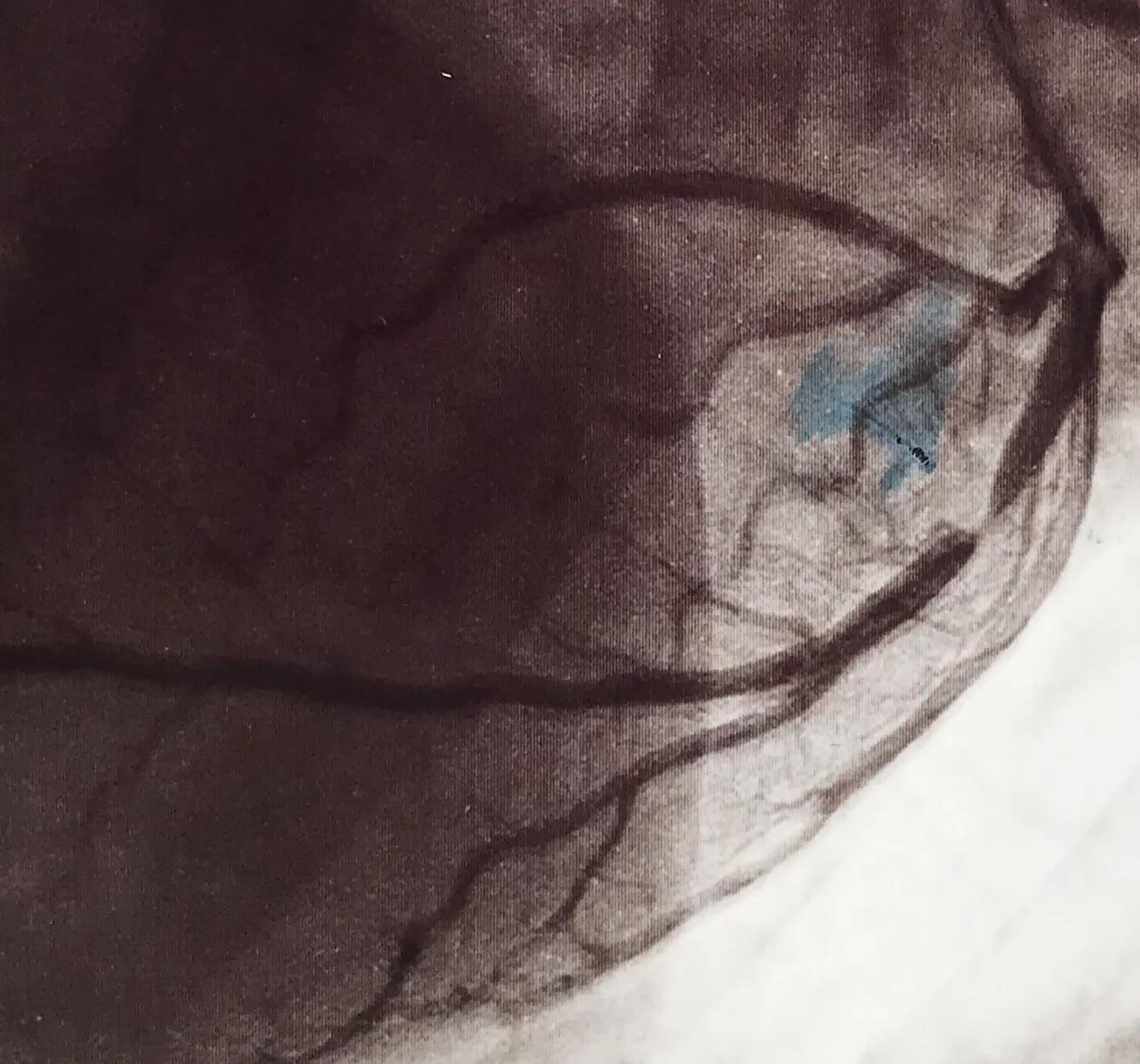 左主干前降支狭窄80%必须支架吗,左前降支近端狭窄65%需要做支架吗