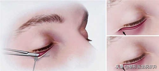 割眼袋和割双眼皮哪个风险大,男士眼袋手术内切有什么风险