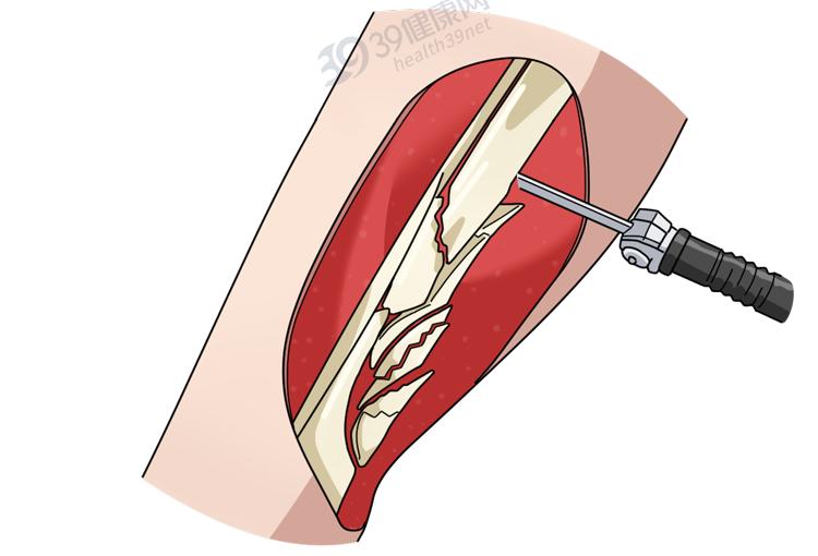 做断骨增高的人怎么样了,做了断骨增高看得出来吗