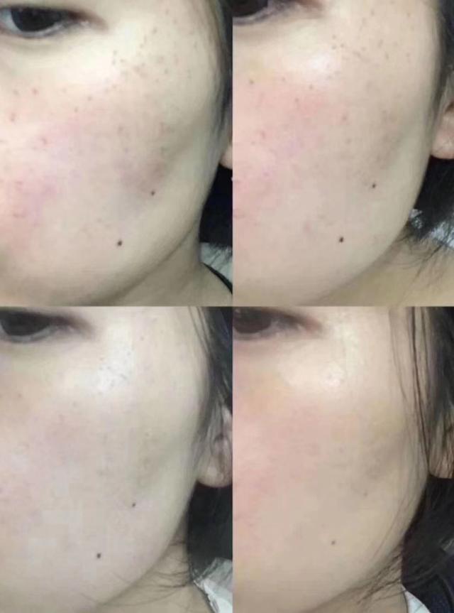 今天治疗，明天上班，激光中的“法拉利”超皮秒