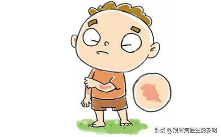 凡士林加西瓜能治好银屑病吗,银屑病西瓜霜和凡士林