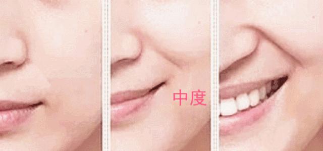 让法令纹和眼袋彻底消失的动作,有法令纹怎样锻炼才能减轻