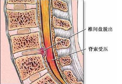 腰疼起来站都站不直？医生：3种锻炼方法让你的腰挺起来