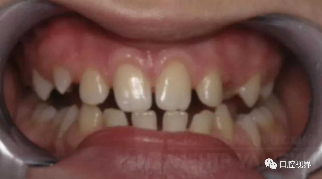 听说牙缝太大难看又露财，您给看看这牙缝还有救吗？