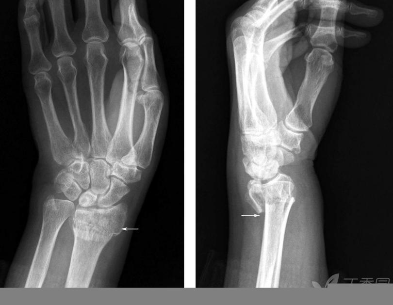 治疗筋伤的膏药,治伤筋止痛的膏药