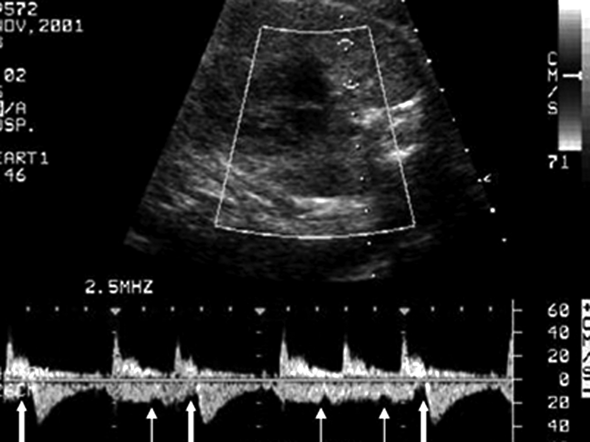 胎儿超声结果显示心跳过速,27周胎儿心律不齐早搏