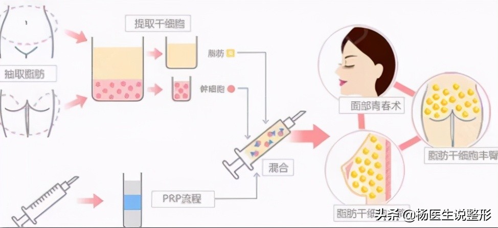 吸脂手术有哪几种类型,吸脂手术很微创