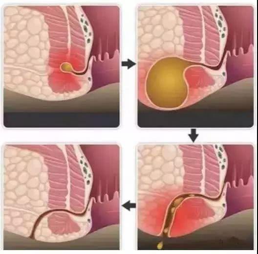 屁股上长火疖子和肛瘘的区别,屁股长脓疮是热毒还是什么