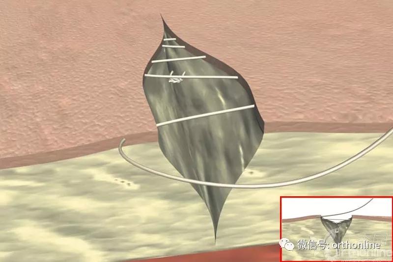 常用的手术缝合方法图,临床常见常用伤口缝合方法
