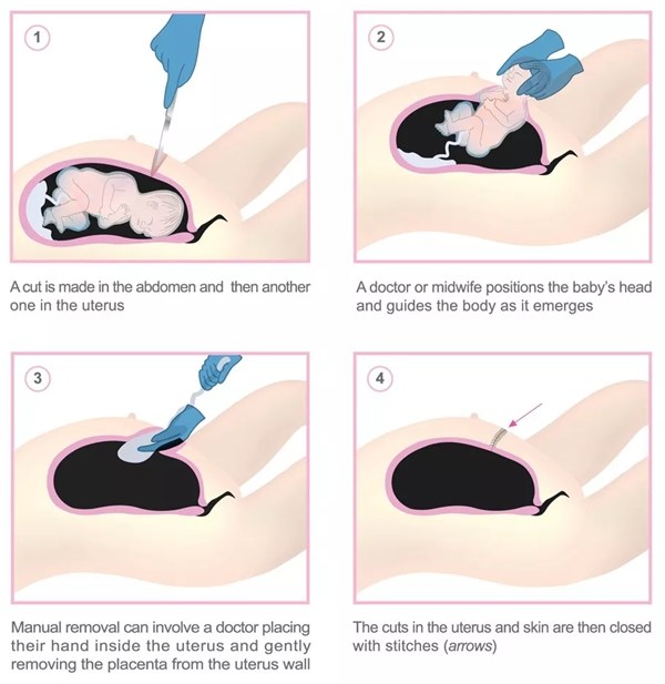 太后悔剖腹产了我该怎么办,剖腹产你们都后悔了吗