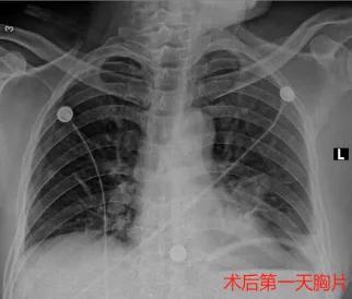 微创医疗最新突破,首例单孔胸腔镜手术