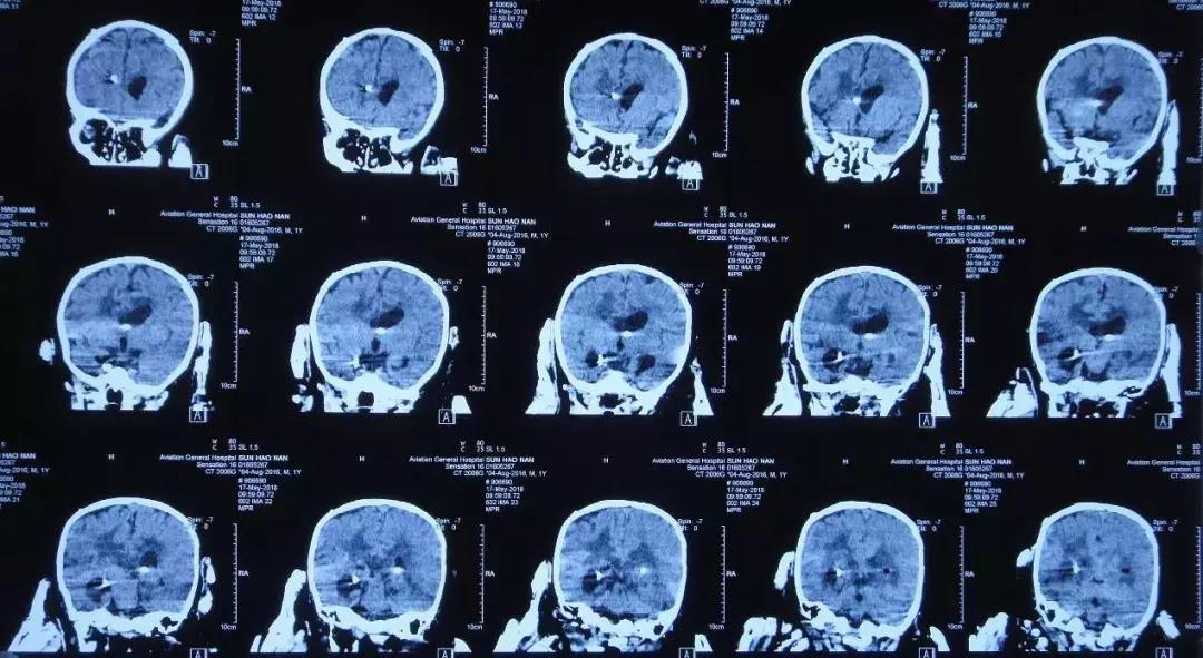 孩子脑积水反复发烧,婴儿脑积水引起发烧如何保守治疗