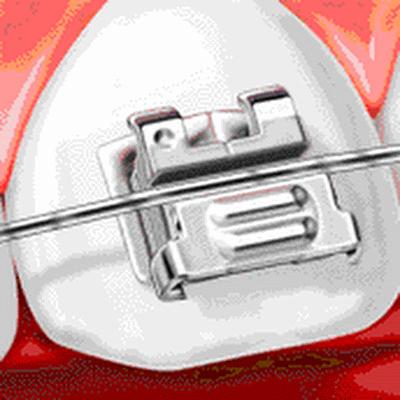 什么情况需要牙齿矫正一般多少钱,为什么去医院矫正牙齿每次都收费