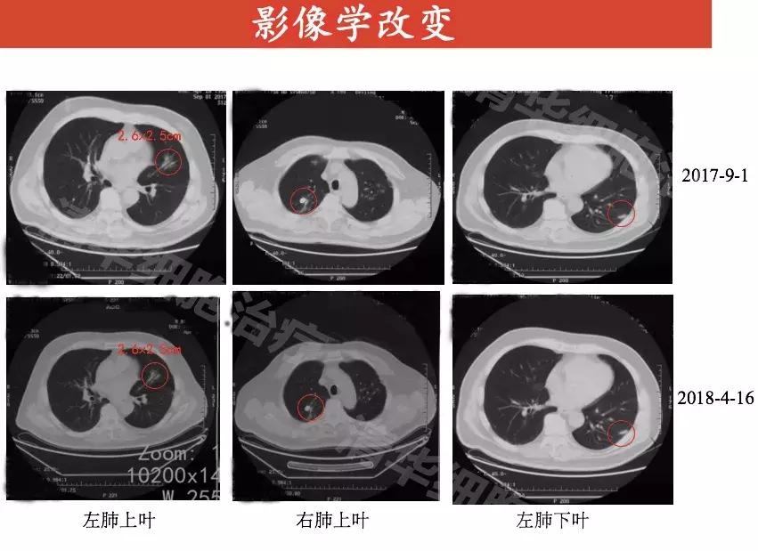 nkt免疫治疗哪些癌症,nkt癌症新疗法
