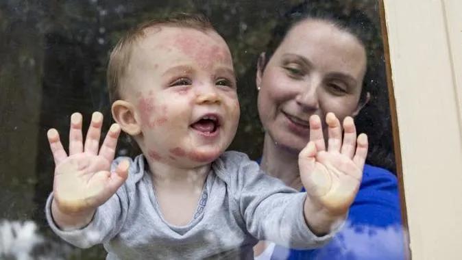 英美流行的奇葩“水痘派对”，是对现代传染病防治的巨大羞辱