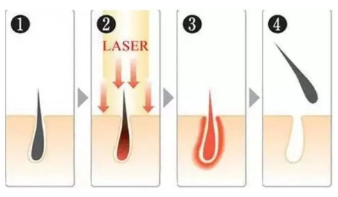 光子脱毛和激光脱毛哪个好,光子脱毛和光子嫩肤仪器区别