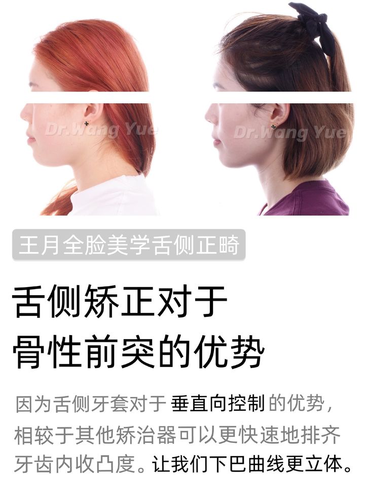 上海舌侧正畸医生,上海舌侧矫正哪家好