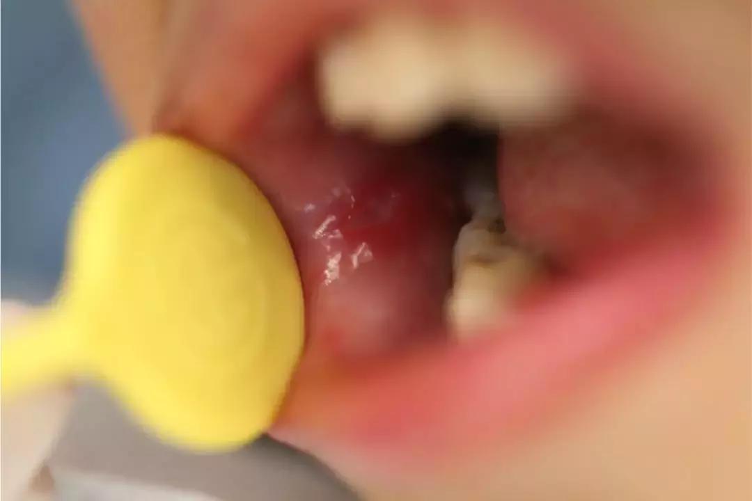 更年期反复口腔溃疡怎么调理,女性反复口腔溃疡是大病前兆