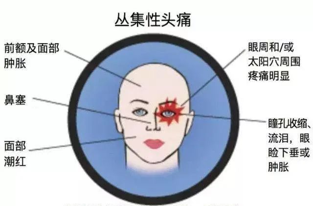 疼痛科治疗头痛的方法,疼痛科怎么治疗头疼