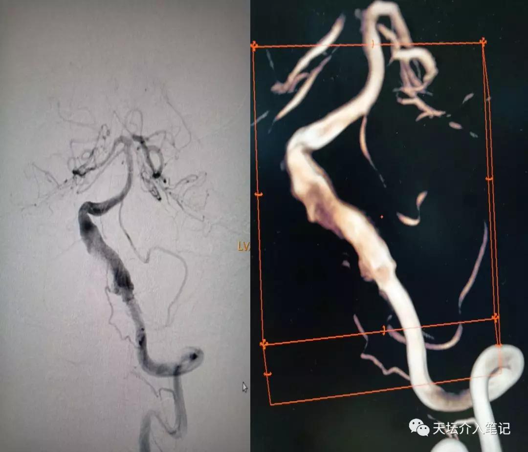 密网支架治疗脑动脉瘤术后效果图,密网支架治疗基底动脉假性动脉瘤