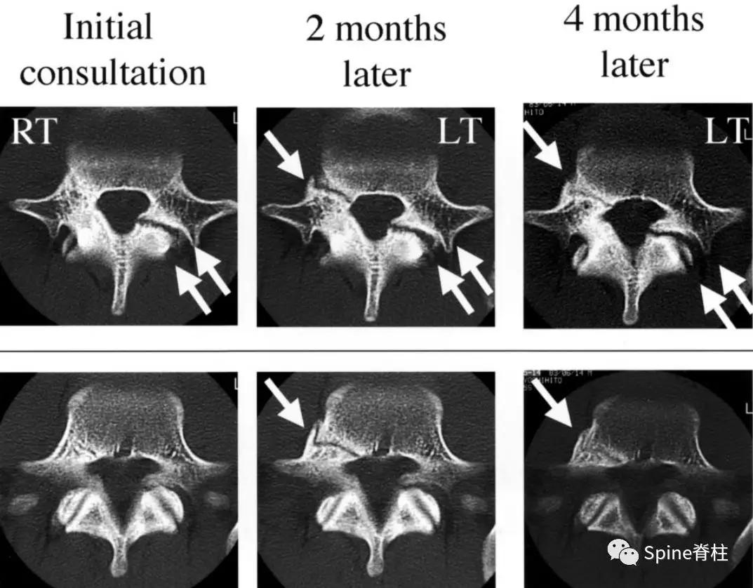 青少年一跑步就腰痛,青少年腰痛是什么原因引起的