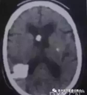 钙化灶是良性肿瘤的可能性大吗,颅内肿瘤钙化发生率最高