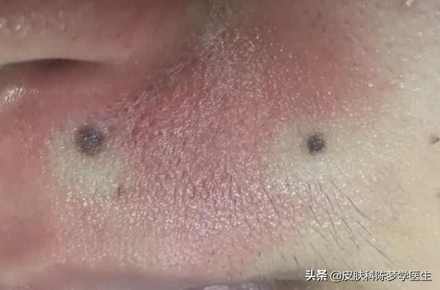 脸上长很多痣是好还是坏,脸上痣发炎红肿是癌变吗