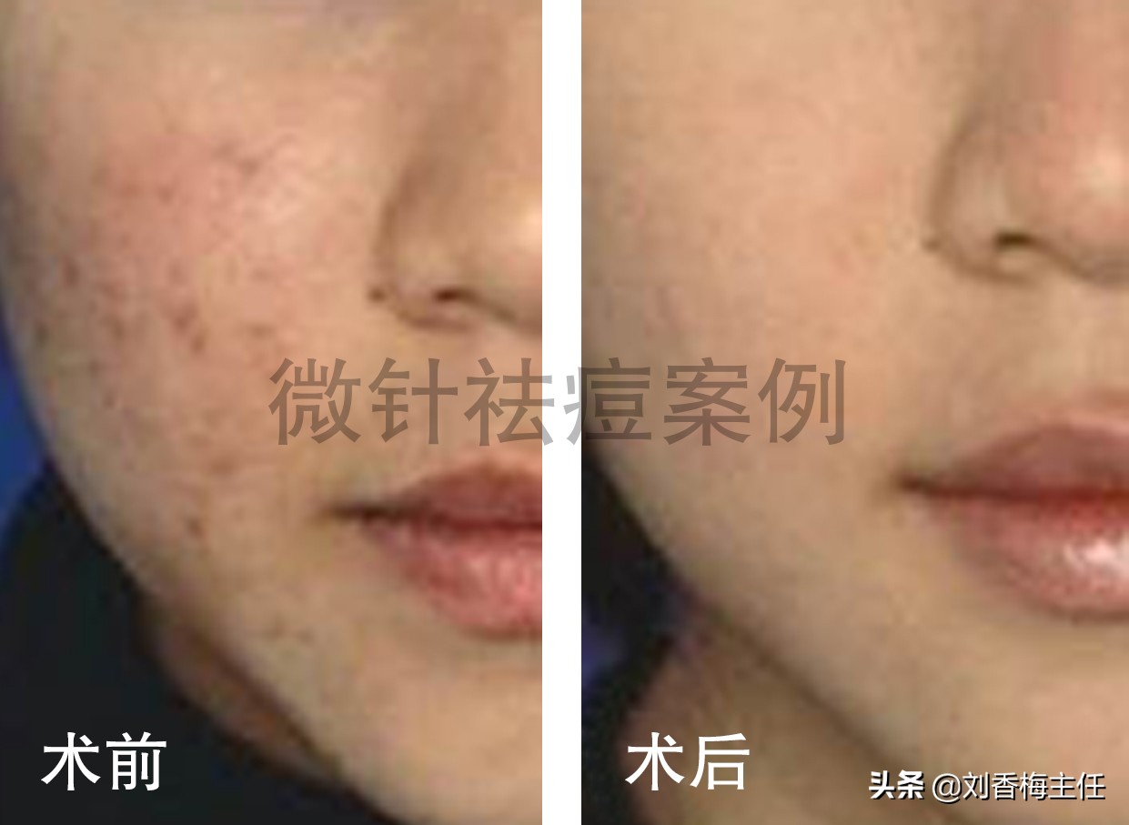 微针全解科普,微针到底有什么效果