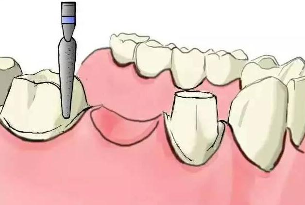 缺失牙如何补救,缺失牙怎么矫正