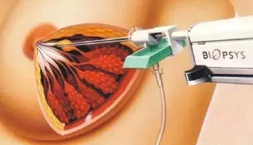 什么是乳腺纤维腺瘤？摸到乳房上有肿块，还不痛，就要小心了