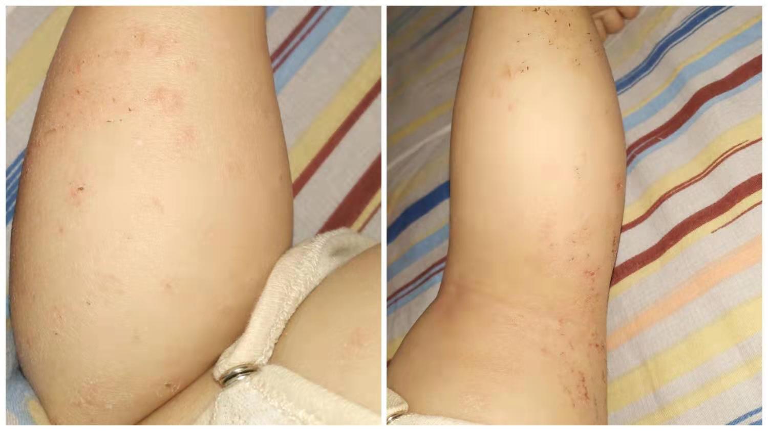 宝宝对牛奶蛋白过敏起湿疹怎么办,牛奶蛋白过敏宝宝能喝正常奶粉吗