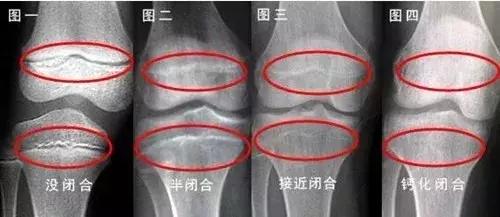 增高术三步骤大揭秘,增高治疗是骗人的吗