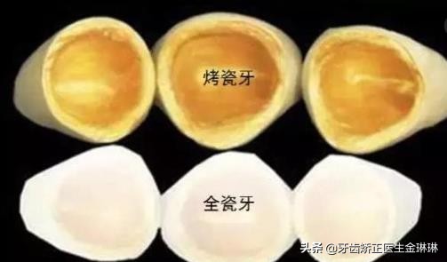 做烤瓷牙一颗3千,做三颗连桥的烤瓷牙多少钱