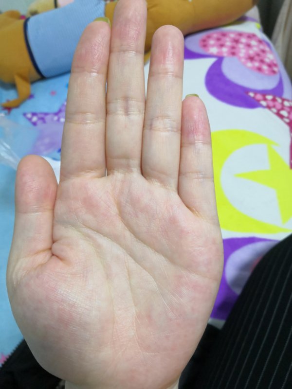 中药治疗腮腺炎、低热患者病案1例（1周）