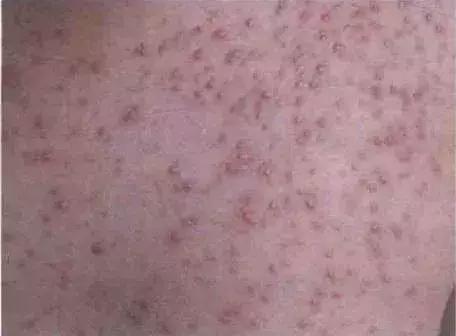 科普真菌感染性皮肤病的防治,专门治疗真菌皮肤病的药膏