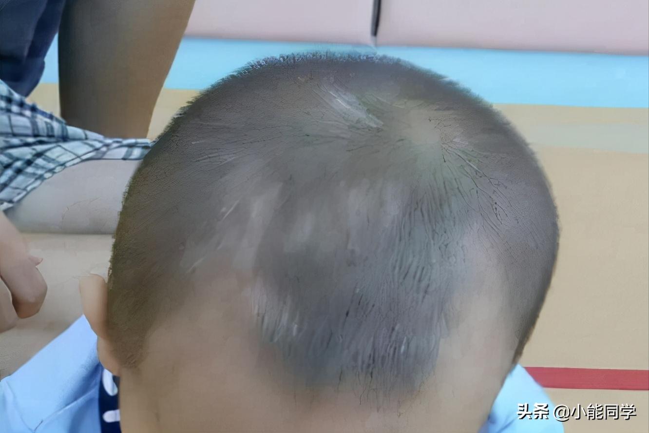 孩子头发稀是缺啥,孩子头发稀黄就是营养不良吗