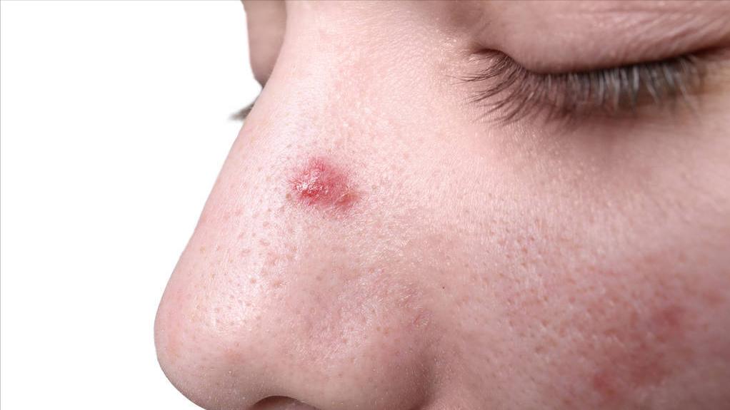 脸上长痘化脓有什么好办法,脸上化脓的痘痘去除最快方法