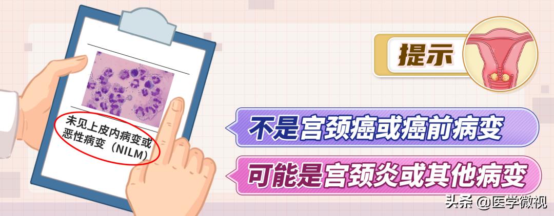 tct和hpv检查哪个确诊宫颈癌,宫颈癌tct检查是什么结果