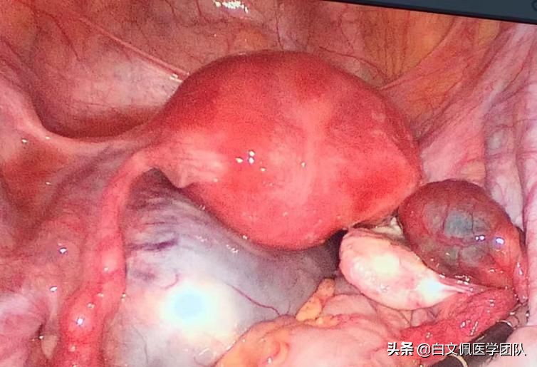 腹腔镜妇科解剖教学视频教程,白文佩医学团队