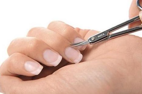 手指倒刺甲沟炎的症状及图片,手指甲沟炎是不是异物引起的