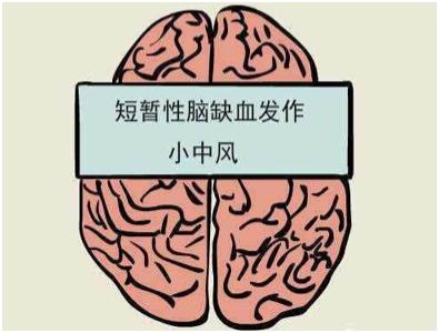 小中风症状有哪些,小中风前兆的十个表现