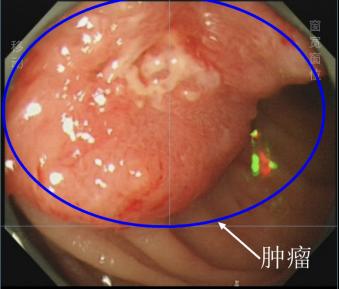 北大深圳医院为肾移植后男子顺利完成手术