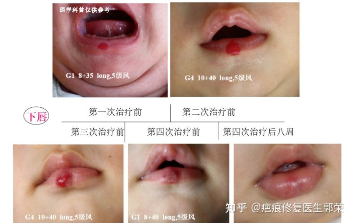 cynergy激光治疗仪副作用,cynergy双波长血管激光